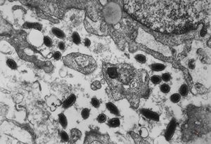 F,41y. | Whipple disease - duodenum